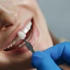 Oferta de Carilla Dental