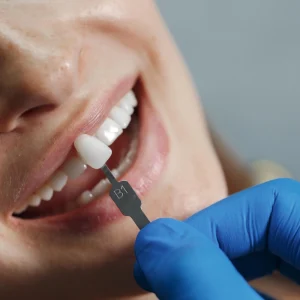 Oferta de Carilla Dental