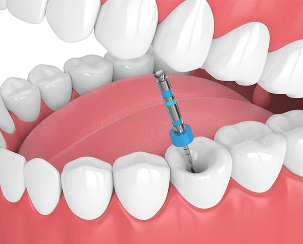 endodoncia-molar-blog-dental-dentalpremium