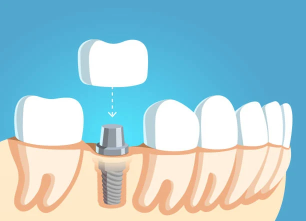 Endodoncia Molar