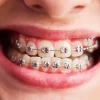 Promociones Brackets Premiumdental