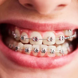 Promociones Brackets Premiumdental