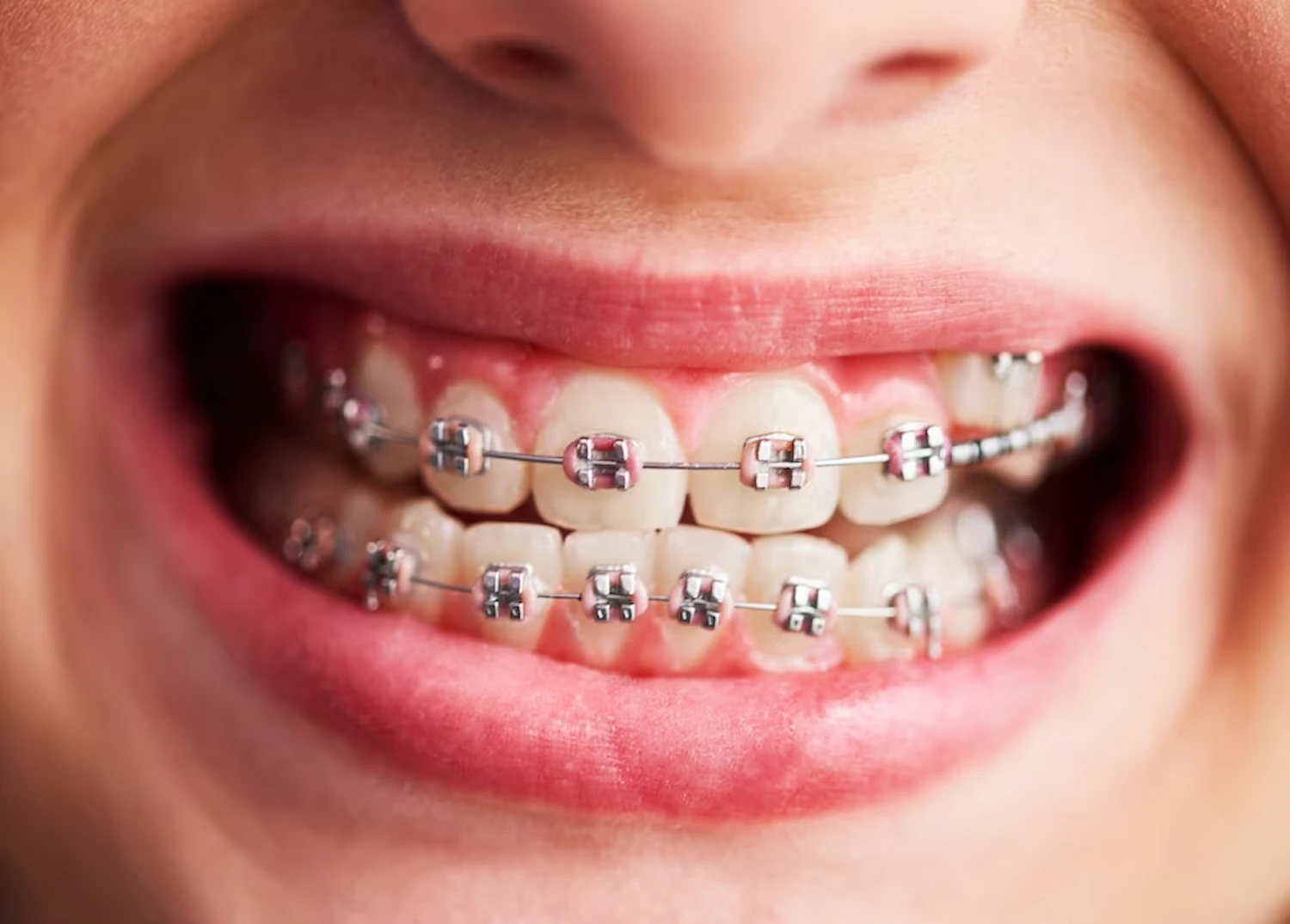Promociones Brackets Premiumdental