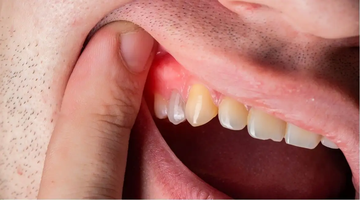 Implante Dental Infectado