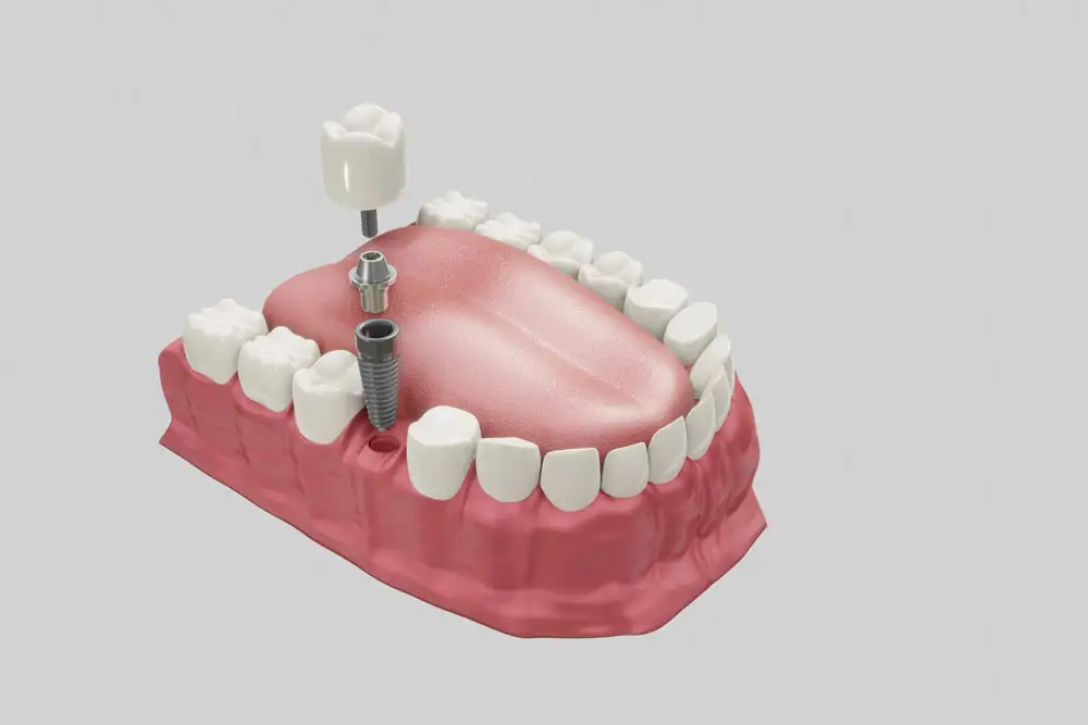 Procedimiento de Implante Dental