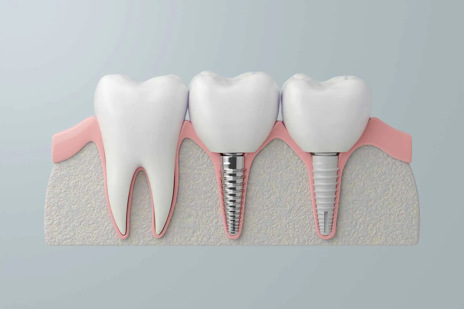 Tipos de Implantes Dentales