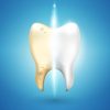 Blanqueamiento dental + Limpieza dental