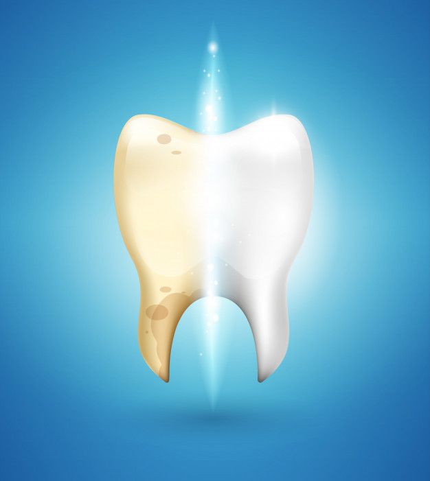 Blanqueamiento dental + Limpieza dental